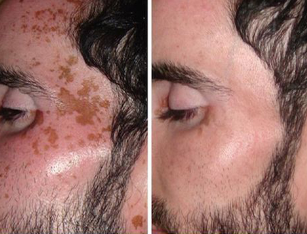 Advanced Skin Tightening, Wrinkles & HIFU Treatment In Delhi - 1