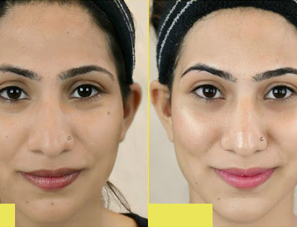 Advanced Skin Tightening, Wrinkles & HIFU Treatment In Delhi - 1